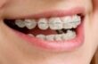 dental-braces-care-8656855